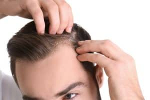 Can I Prevent Dandruff without Remedies and Medications 1